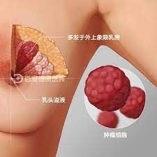 最新研究揭示：双侧乳房切除术为何无法提高乳腺癌生存率